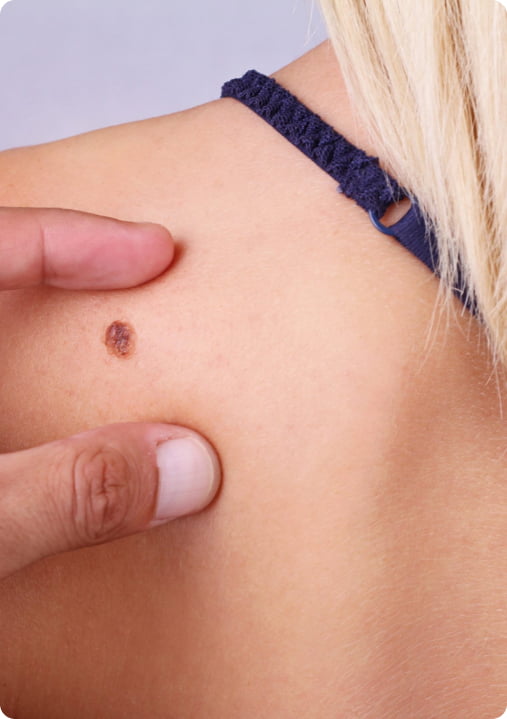 Imagem ilustrativa Cirurgia de Mohs
